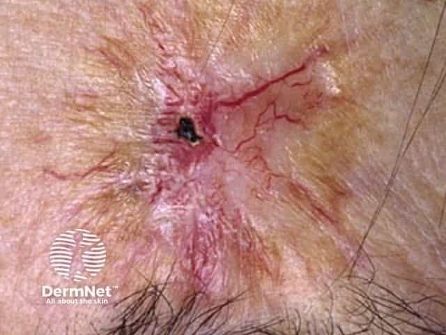 Basal cell carcinoma affecting the face