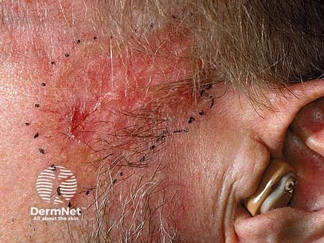 Basal cell carcinoma affecting the face