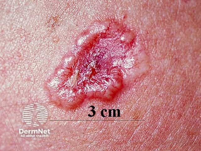 Basal cell carcinoma affecting the face