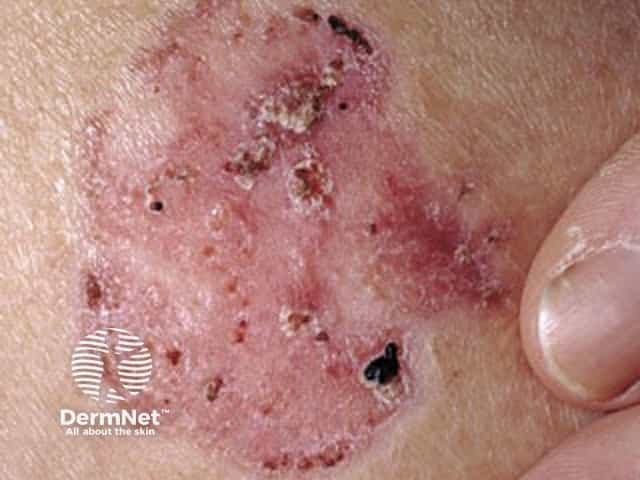 Basal cell carcinoma affecting the face