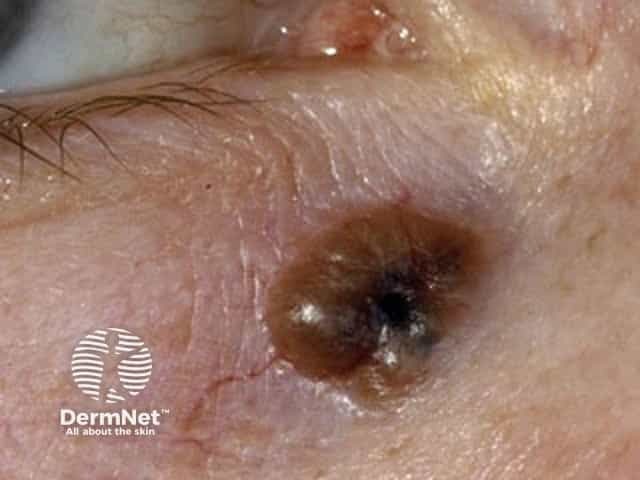 Basal cell carcinoma affecting the face