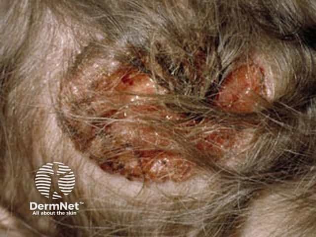 Basal cell carcinoma affecting the face