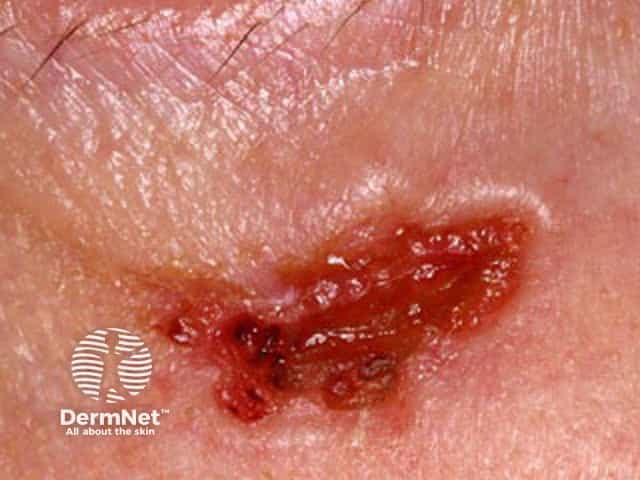 Basal cell carcinoma affecting the face