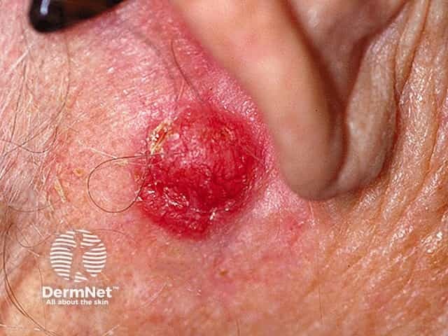 Basal cell carcinoma affecting the face