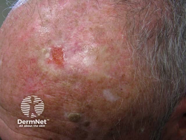 Basal cell carcinoma affecting the face