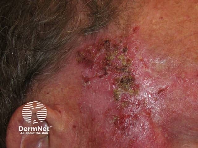 Basal cell carcinoma affecting the face