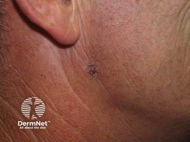 Basal cell carcinoma affecting the face