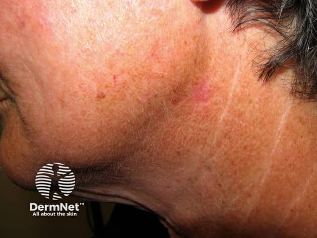 Basal cell carcinoma affecting the face