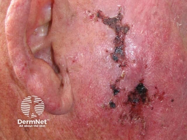 Basal cell carcinoma affecting the face