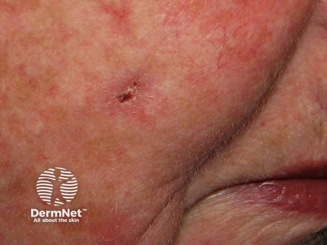 Basal cell carcinoma affecting the face