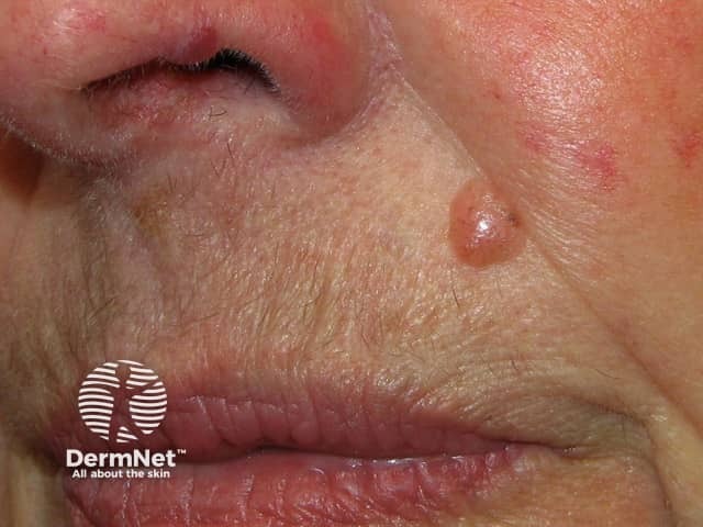 Basal cell carcinoma affecting the face