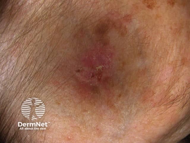 Basal cell carcinoma affecting the face