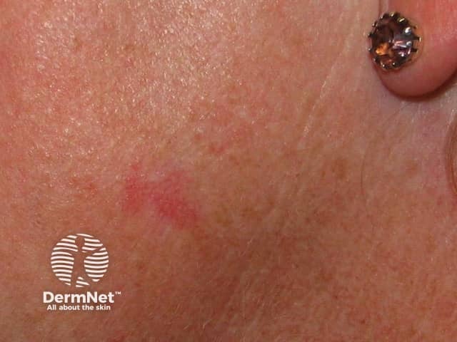 Basal cell carcinoma affecting the face