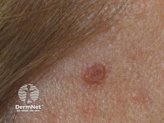 Basal cell carcinoma affecting the face