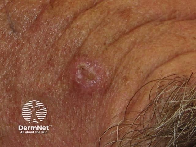 Basal cell carcinoma affecting the face