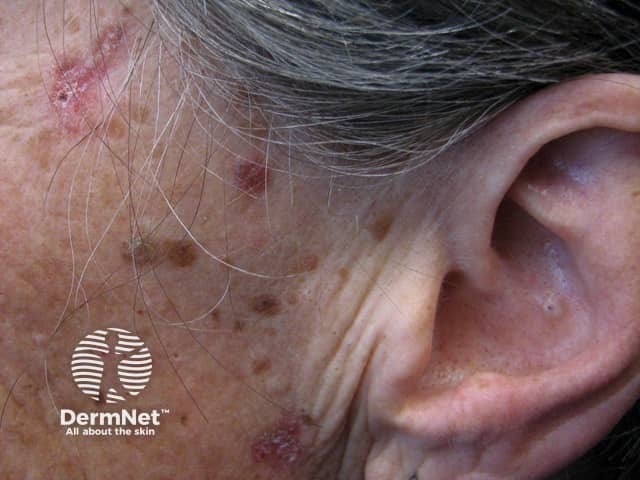 Basal cell carcinoma affecting the face