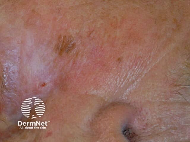 Basal cell carcinoma affecting the face