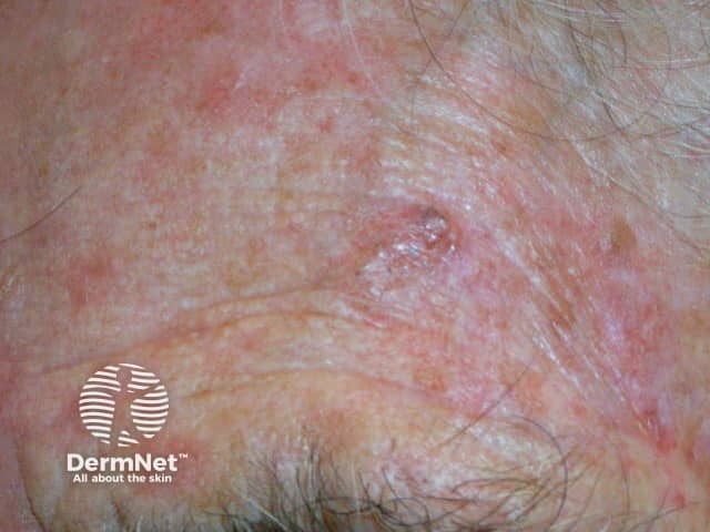 Basal cell carcinoma affecting the face