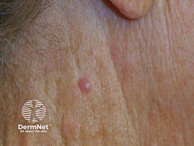 Basal cell carcinoma affecting the face