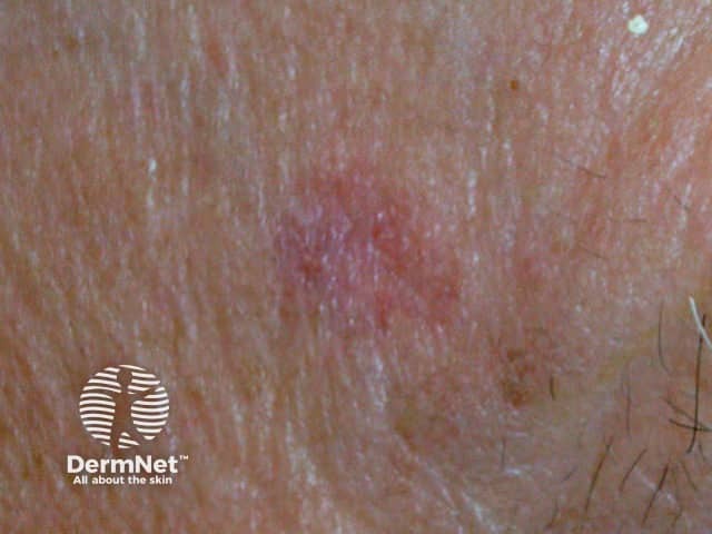 Basal cell carcinoma affecting the face