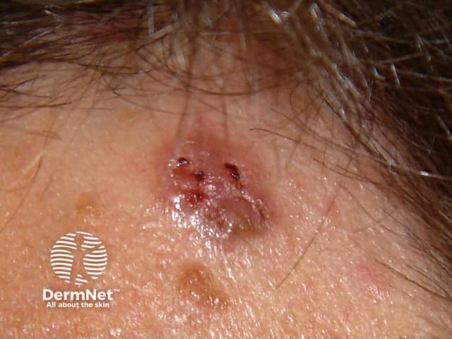 Basal cell carcinoma affecting the face