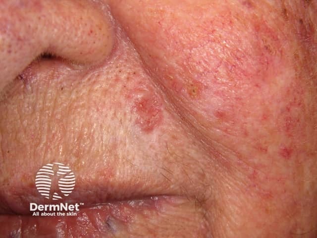 Basal cell carcinoma affecting the face