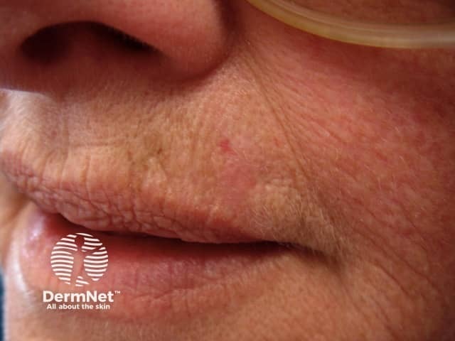 Basal cell carcinoma affecting the face