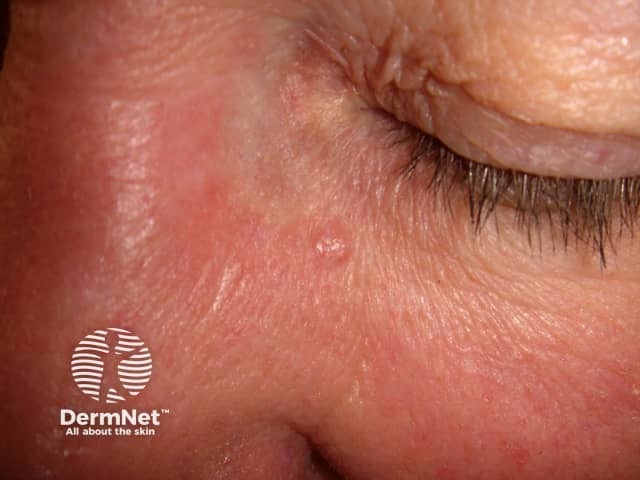 Basal cell carcinoma affecting the face