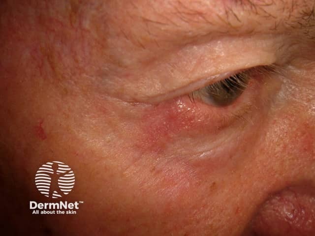 Basal cell carcinoma affecting the face