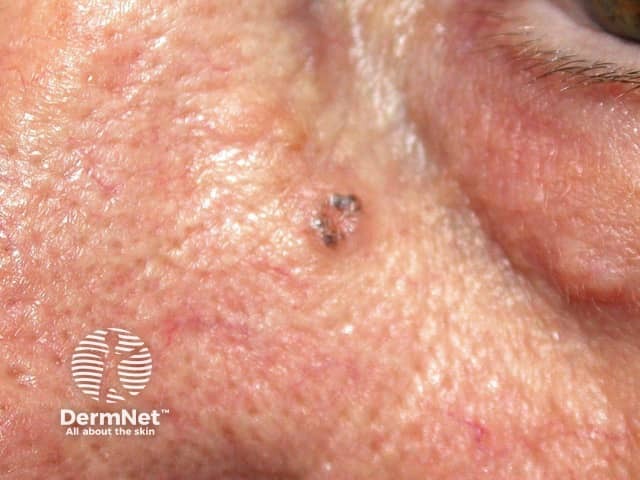 Basal cell carcinoma affecting the face