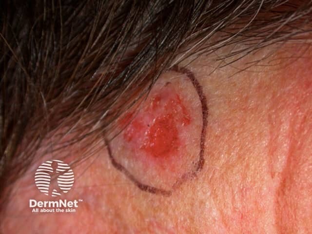 Basal cell carcinoma affecting the face