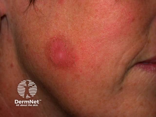 Basal cell carcinoma affecting the face