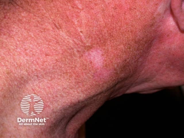 Basal cell carcinoma affecting the face