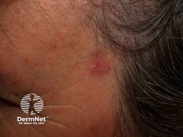 Basal cell carcinoma affecting the face