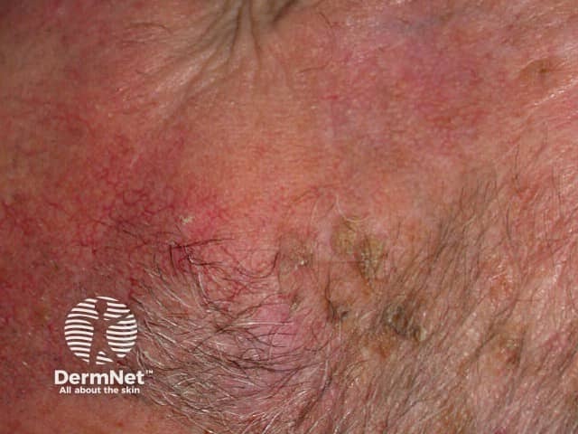 Basal cell carcinoma affecting the face