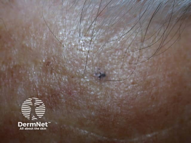 Basal cell carcinoma affecting the face