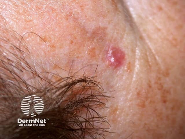 Basal cell carcinoma affecting the face