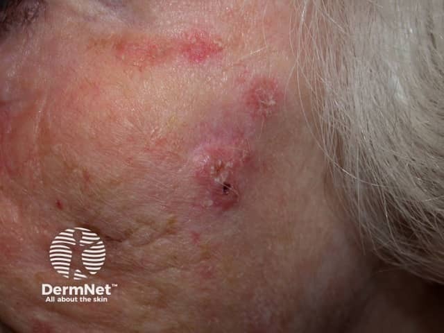 Basal cell carcinoma affecting the face