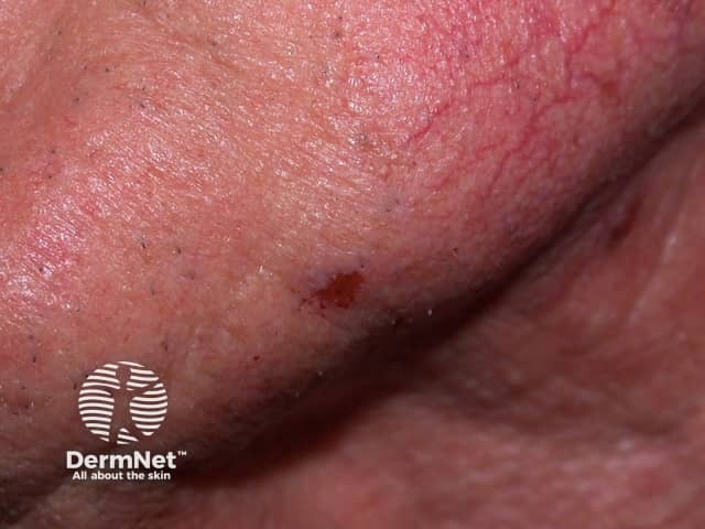 Basal cell carcinoma affecting the face