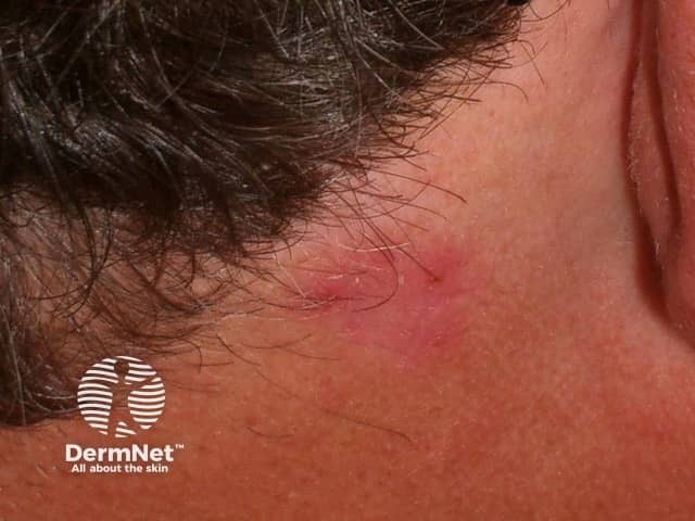 Basal cell carcinoma affecting the face