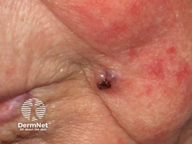 Basal cell carcinoma affecting the face