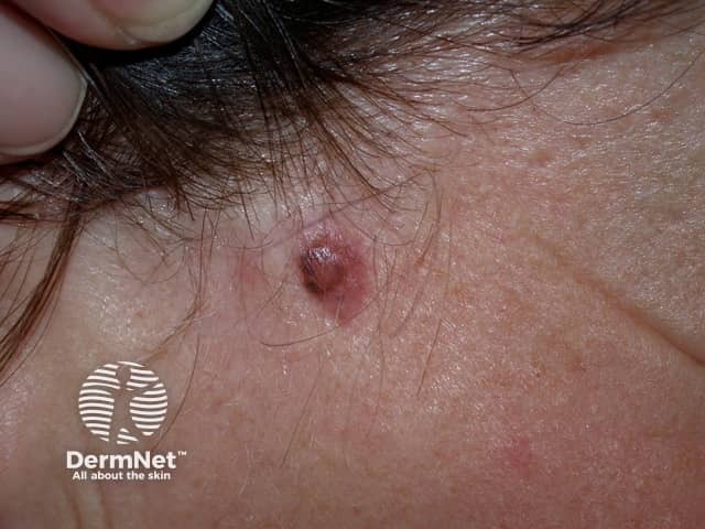 Basal cell carcinoma affecting the face