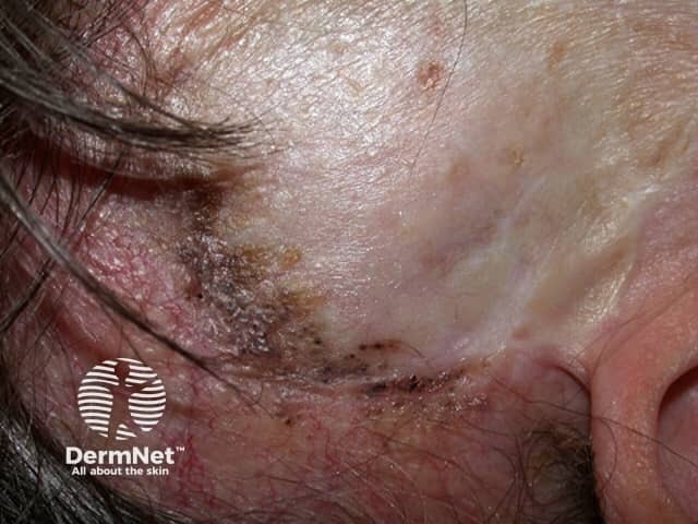 Basal cell carcinoma affecting the face