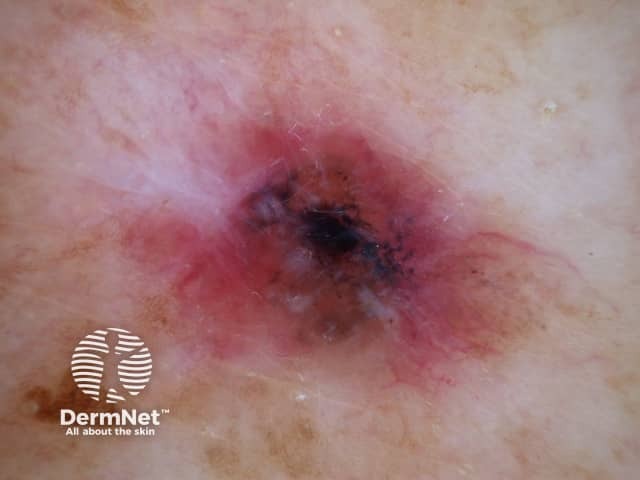 Basal cell carcinoma affecting the face