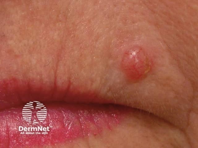 Basal cell carcinoma affecting the face