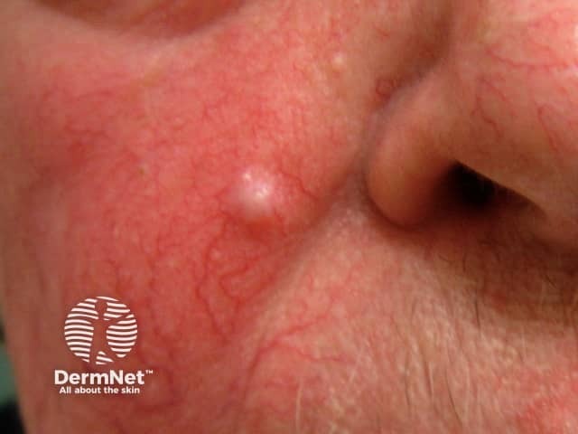 Basal cell carcinoma affecting the face