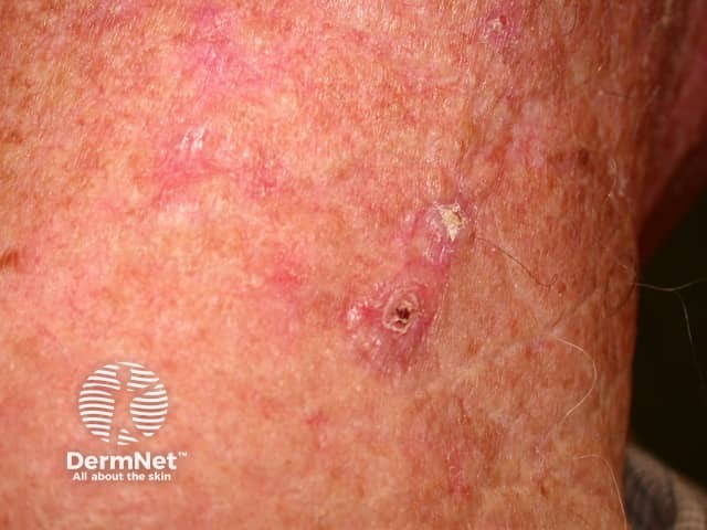 Basal cell carcinoma affecting the face