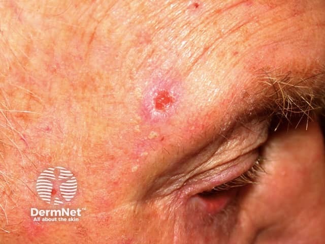 Basal cell carcinoma affecting the face