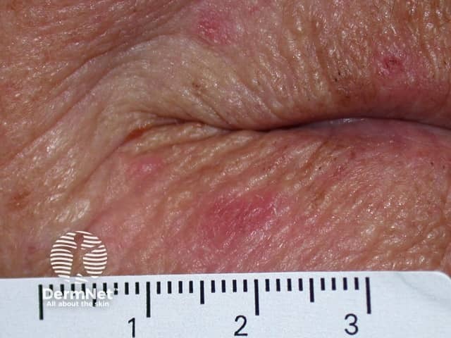 Basal cell carcinoma affecting the face