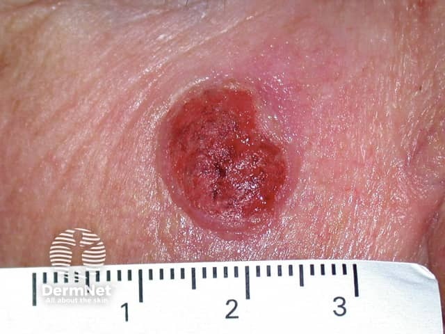 Basal cell carcinoma affecting the face